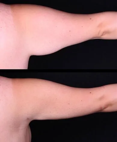 Caso 3: braço, antes e depois