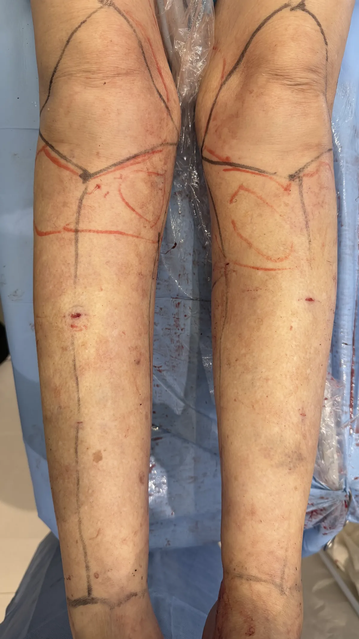 Planejamento de lipoaspiração de pernas com marcação de áreas e vetores